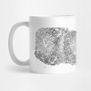 Fatty infiltration of the liver Mug